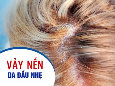 Vảy nến da đầu nhẹ và những thông tin hữu ích dành cho bạn